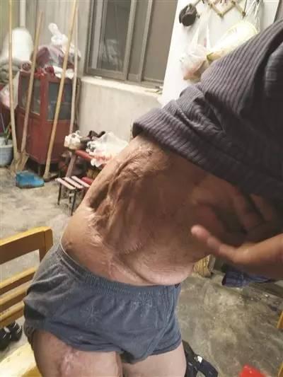 探傷時放射源丟失 受害者終身殘疾 